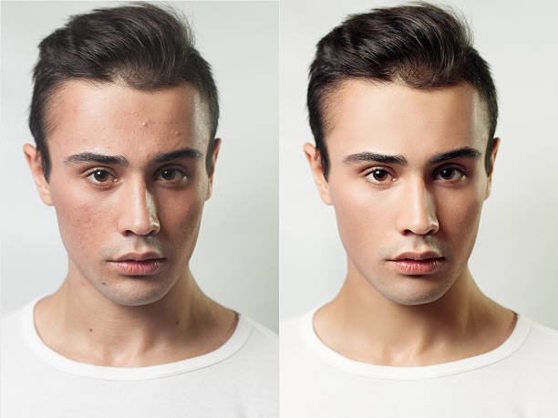Young man before and after photo after skin care routine