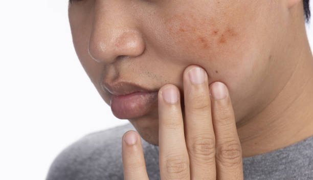 Young man worry dark spots and melasma on his face.
